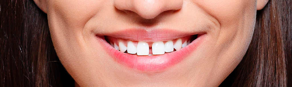 diastema dental