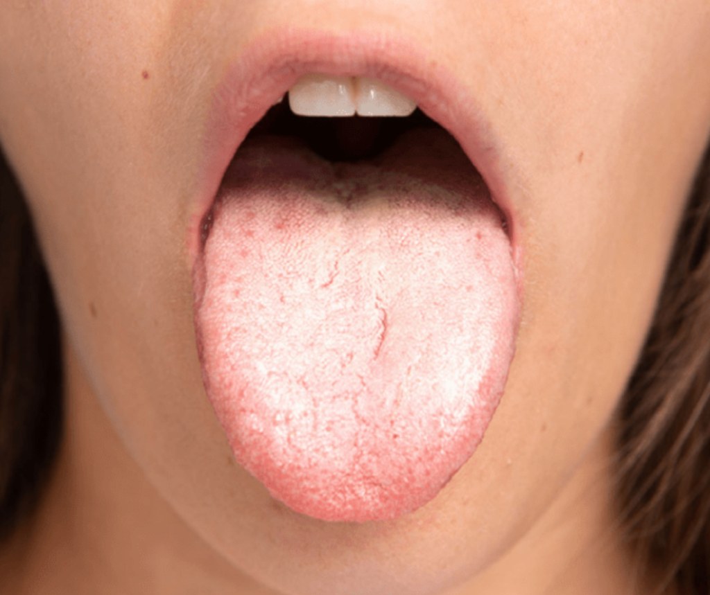 candidiasis oral