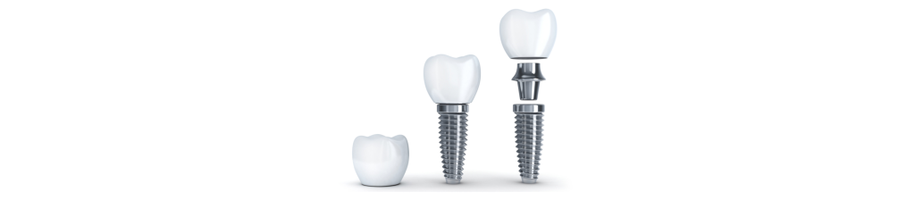 Implantes dentales indoloros en Barcelona