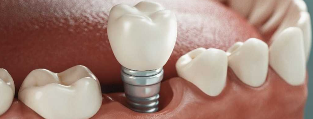 Implantes dentales indoloros en Barcelona