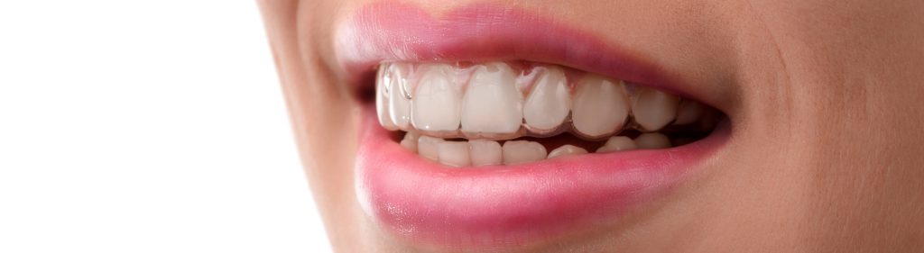 Beneficios de la Ortodoncia Invisible