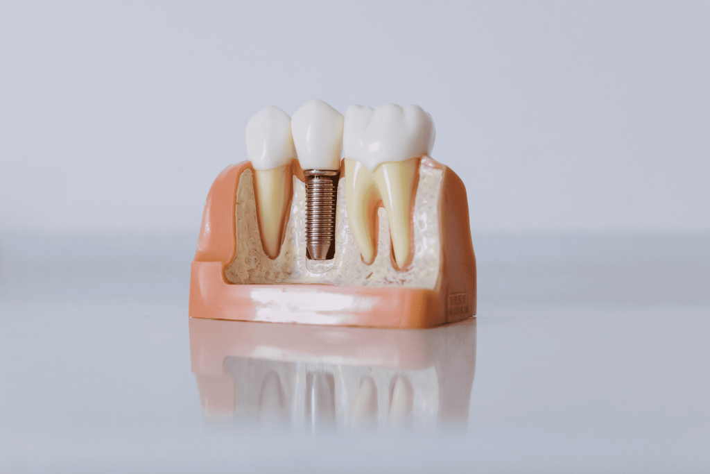 ¿Qué es un puente dental y cuándo se recomienda?