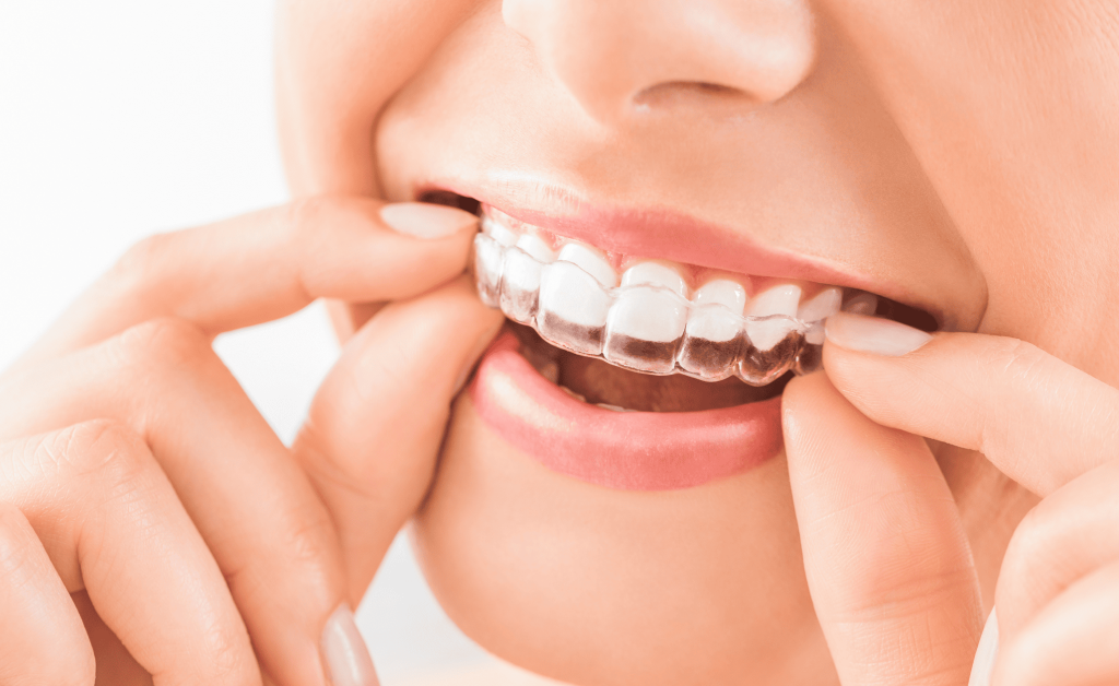 ¿Qué es un retenedor dental y por qué es importante después de la ortodoncia?