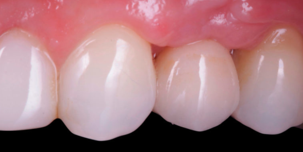 perdida hueso dental