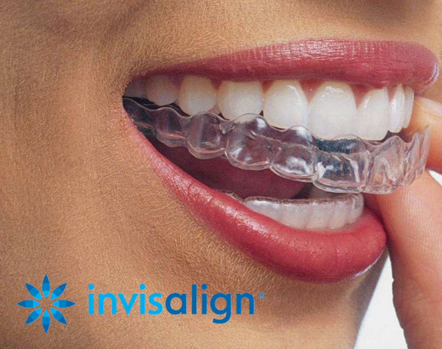 Invisalign Barcelona