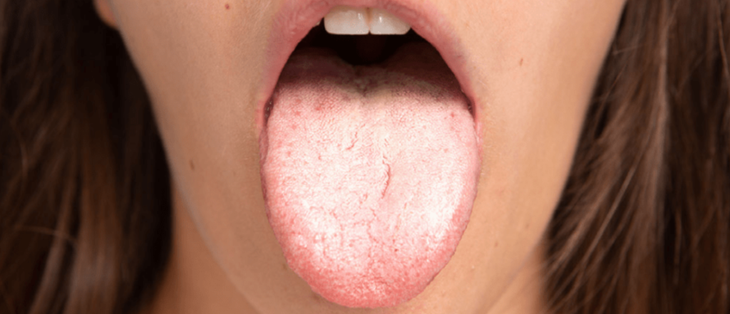 candidiasis oral