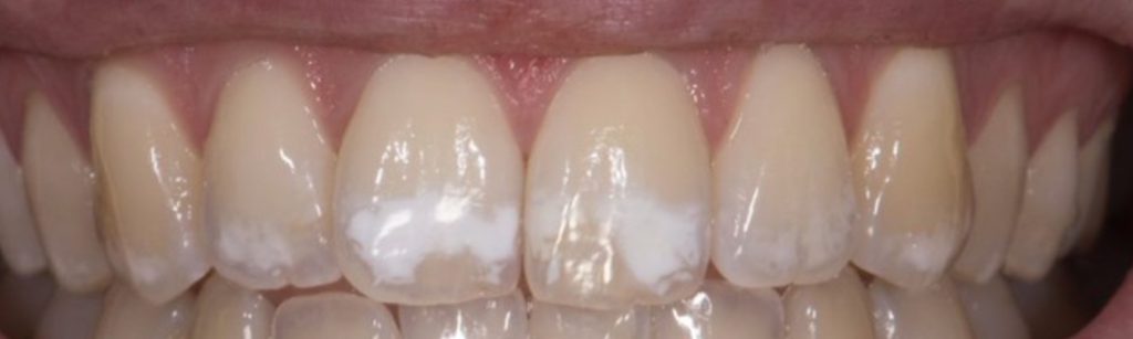 manchas blancas en los dientes