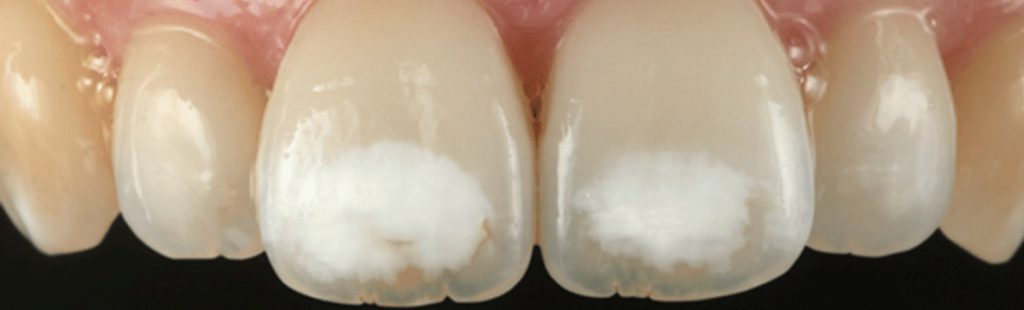 manchas blancas dientes