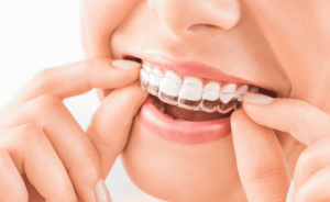 ¿Qué es un retenedor dental y por qué es importante después de la ortodoncia?