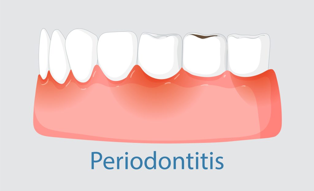 Periodontitis: prevención para evitar la pérdida dental