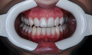 Periodontitis: prevención para evitar la pérdida dental