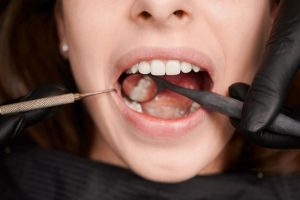 ¿Qué es una endodoncia y en qué casos se recomienda?