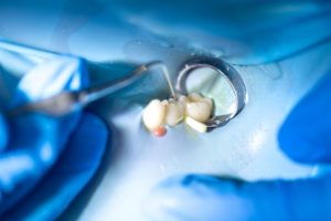 Restauración dental: tratamientos para recuperar la función y estética de tus dientes