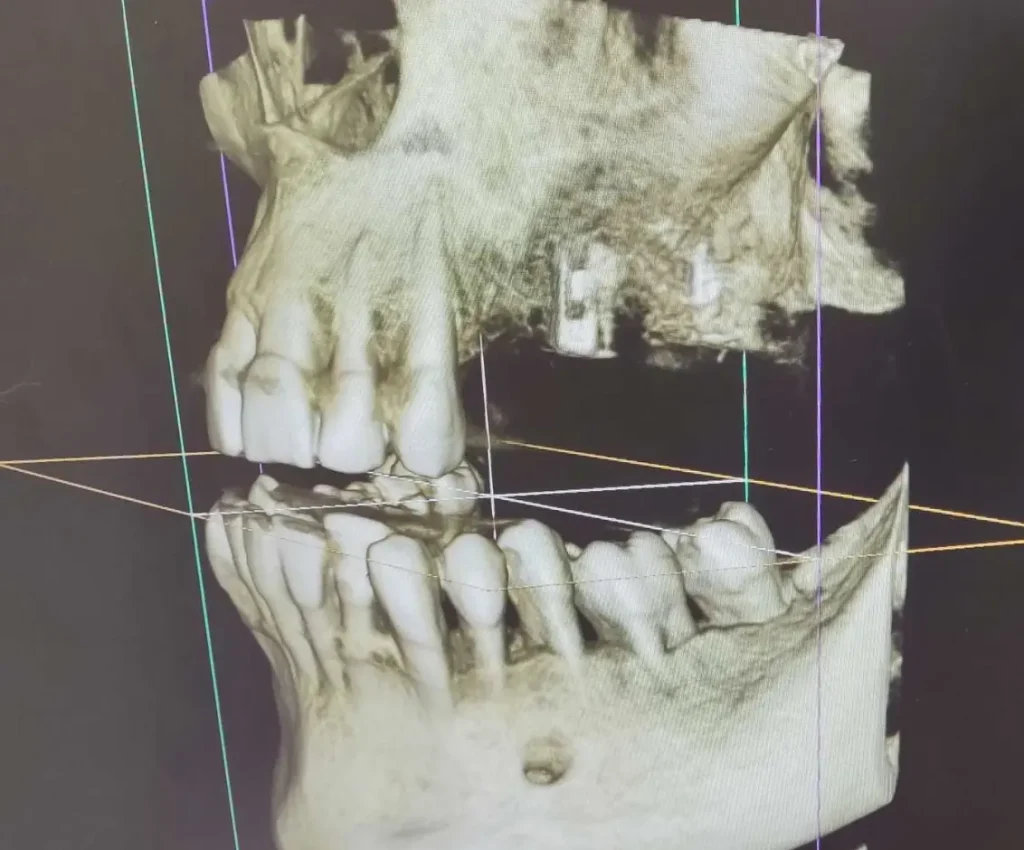 Equipo TAC dental 3D (CBCT) de Clínica Dental Ortoimplants Premium en Barcelona